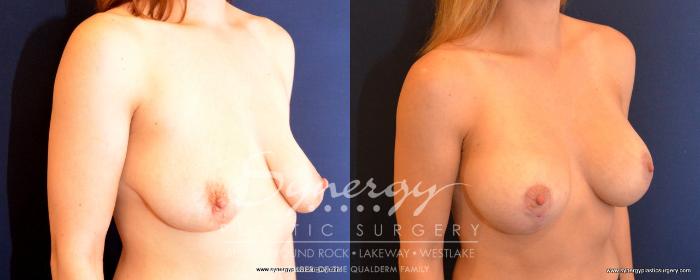 Before & After Breast Lift & Breast Augmentation Case 496 View #4 View in Austin, TX