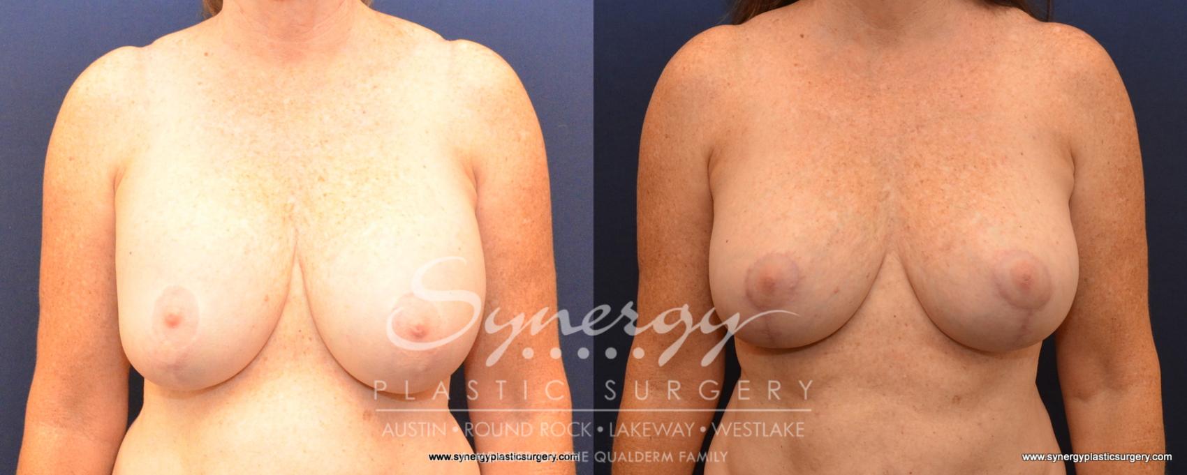 Before & After Breast Lift & Breast Augmentation Case 533 View #1 View in Austin, TX