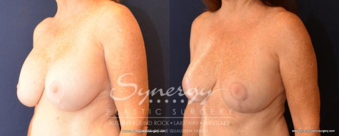 Before & After Breast Lift & Breast Augmentation Case 533 View #2 View in Austin, TX