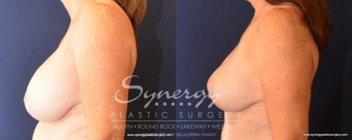 Before & After Breast Lift & Breast Augmentation Case 533 View #3 View in Austin, TX