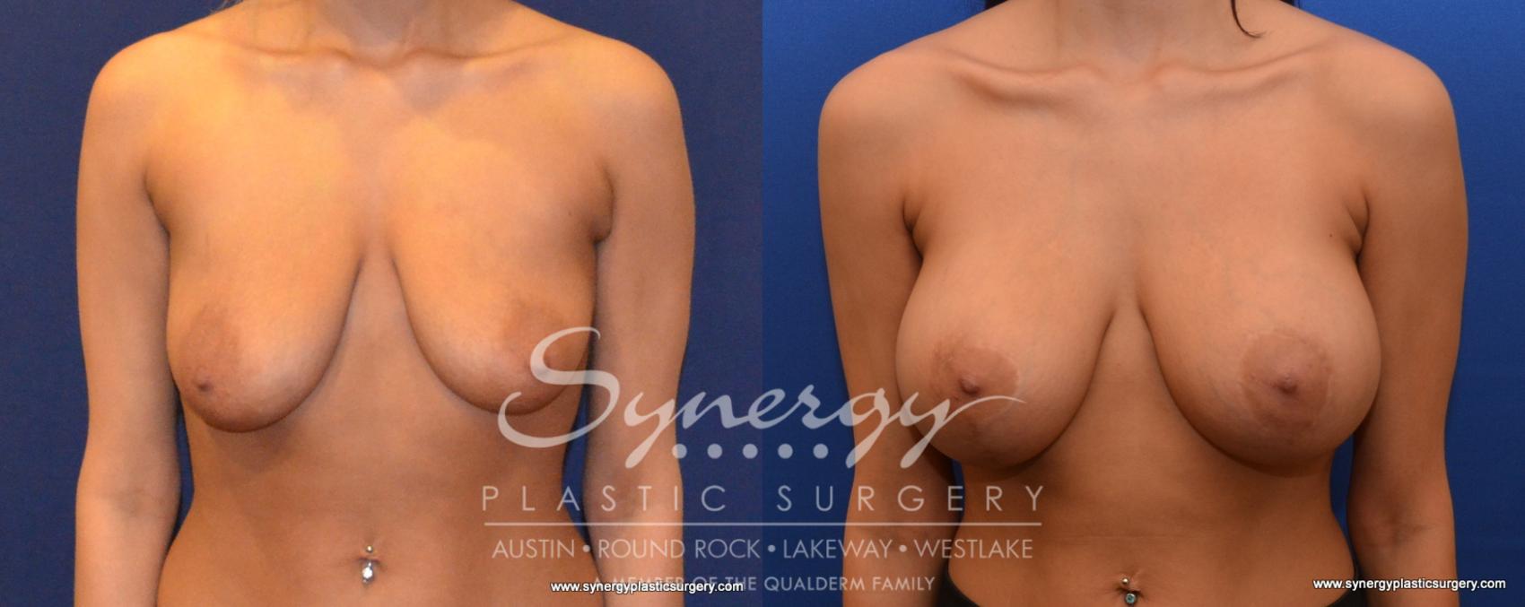 Before & After Breast Lift & Breast Augmentation Case 536 View #1 View in Austin, TX