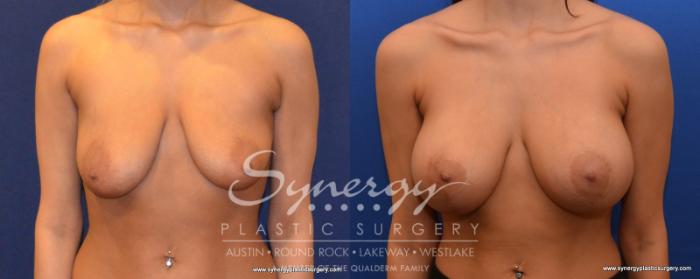 Before & After Breast Lift & Breast Augmentation Case 536 View #1 View in Austin, TX