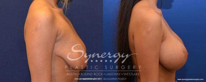 Before & After Breast Lift & Breast Augmentation Case 536 View #2 View in Austin, TX