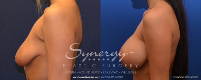 Before & After Breast Lift & Breast Augmentation Case 536 View #3 View in Austin, TX