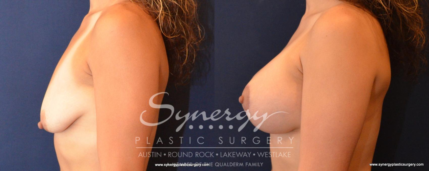 Before & After Breast Lift & Breast Augmentation Case 548 View #3 View in Austin, TX