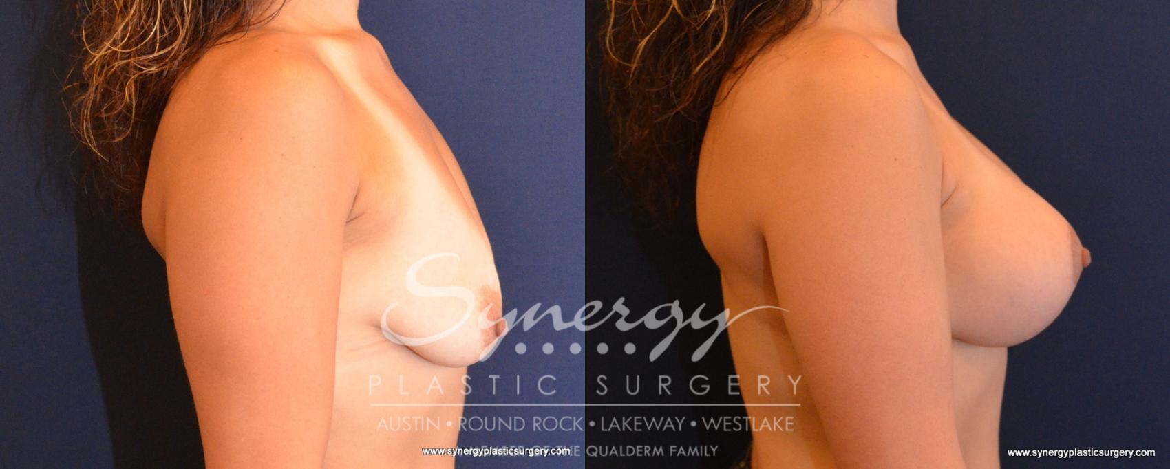 Before & After Breast Lift & Breast Augmentation Case 548 View #5 View in Austin, TX