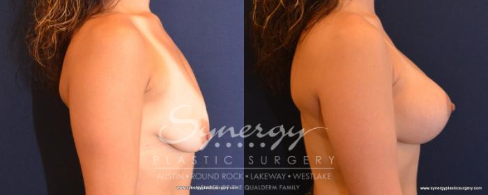 Before & After Breast Lift & Breast Augmentation Case 548 View #5 View in Austin, TX
