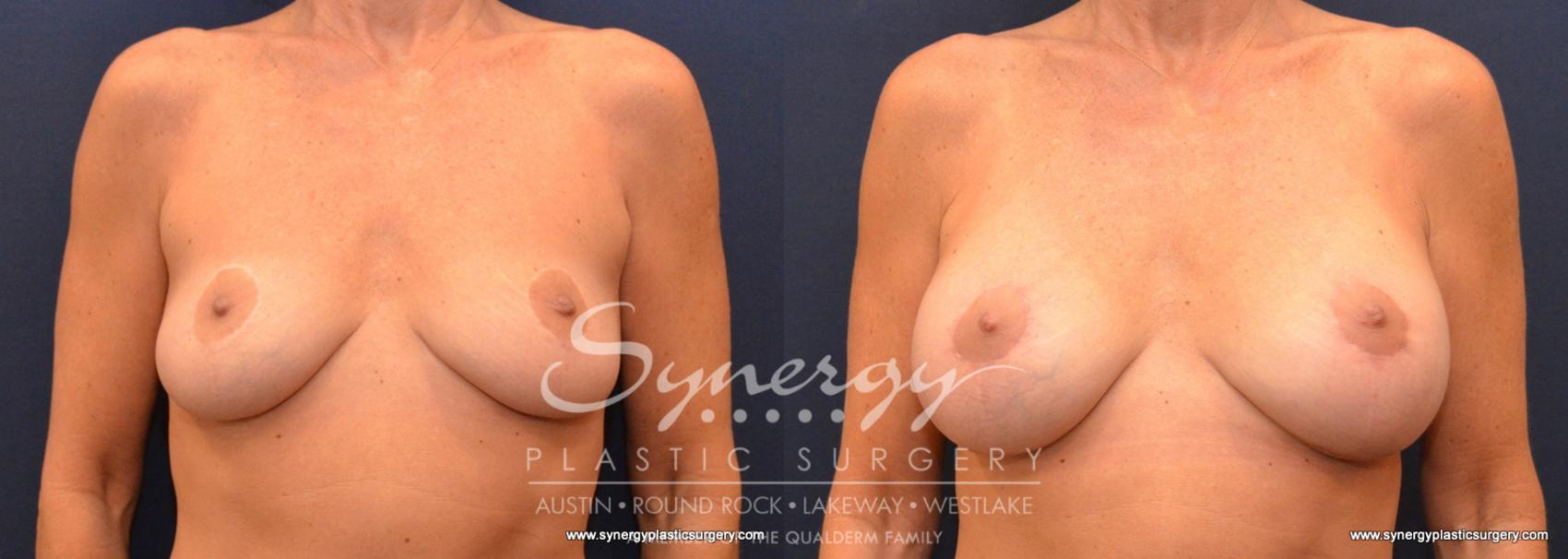 Before & After Breast Lift & Breast Augmentation Case 579 View #1 View in Austin, TX