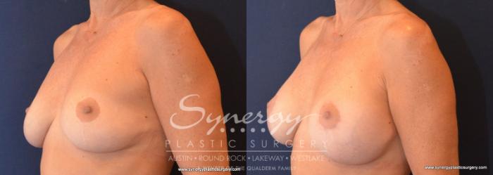 Before & After Breast Lift & Breast Augmentation Case 579 View #2 View in Austin, TX