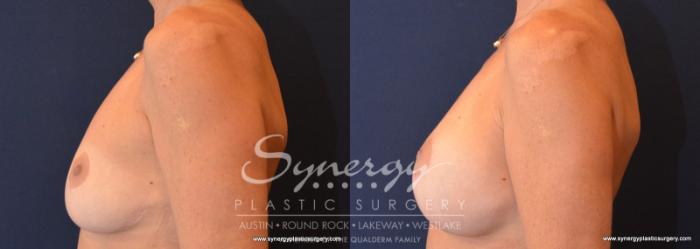 Before & After Breast Lift & Breast Augmentation Case 579 View #3 View in Austin, TX