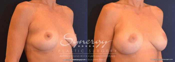 Before & After Breast Lift & Breast Augmentation Case 579 View #4 View in Austin, TX