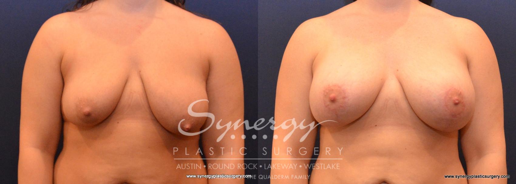 Before & After Breast Lift & Breast Augmentation Case 588 View #1 View in Austin, TX