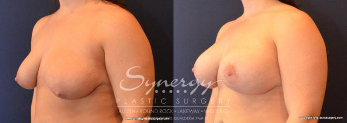 Before & After Breast Lift & Breast Augmentation Case 588 View #2 View in Austin, TX