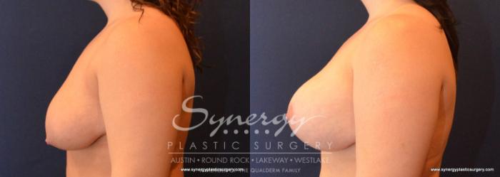 Before & After Breast Lift & Breast Augmentation Case 588 View #3 View in Austin, TX