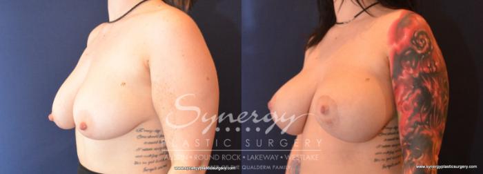 Before & After Breast Lift & Breast Augmentation Case 594 View #2 View in Austin, TX