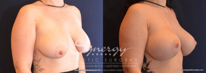 Before & After Breast Lift & Breast Augmentation Case 594 View #5 View in Austin, TX