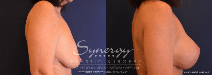 Before & After  Case 652 View #5 View in Austin, TX