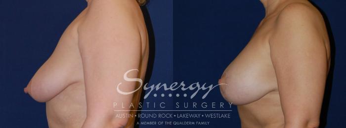 Before & After  Case 72 View #2 View in Austin, TX