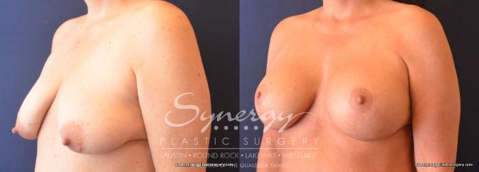 Before & After  Case 739 View #2 View in Austin, TX