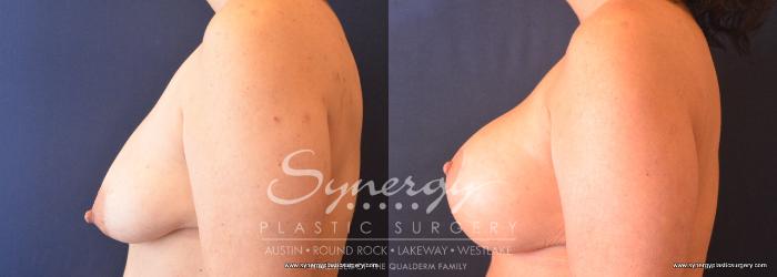 Before & After  Case 739 View #3 View in Austin, TX