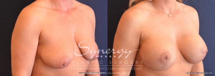 Before & After Breast Lift & Breast Augmentation Case 746 View #2 View in Austin, TX