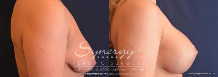 Before & After Breast Lift & Breast Augmentation Case 746 View #3 View in Austin, TX