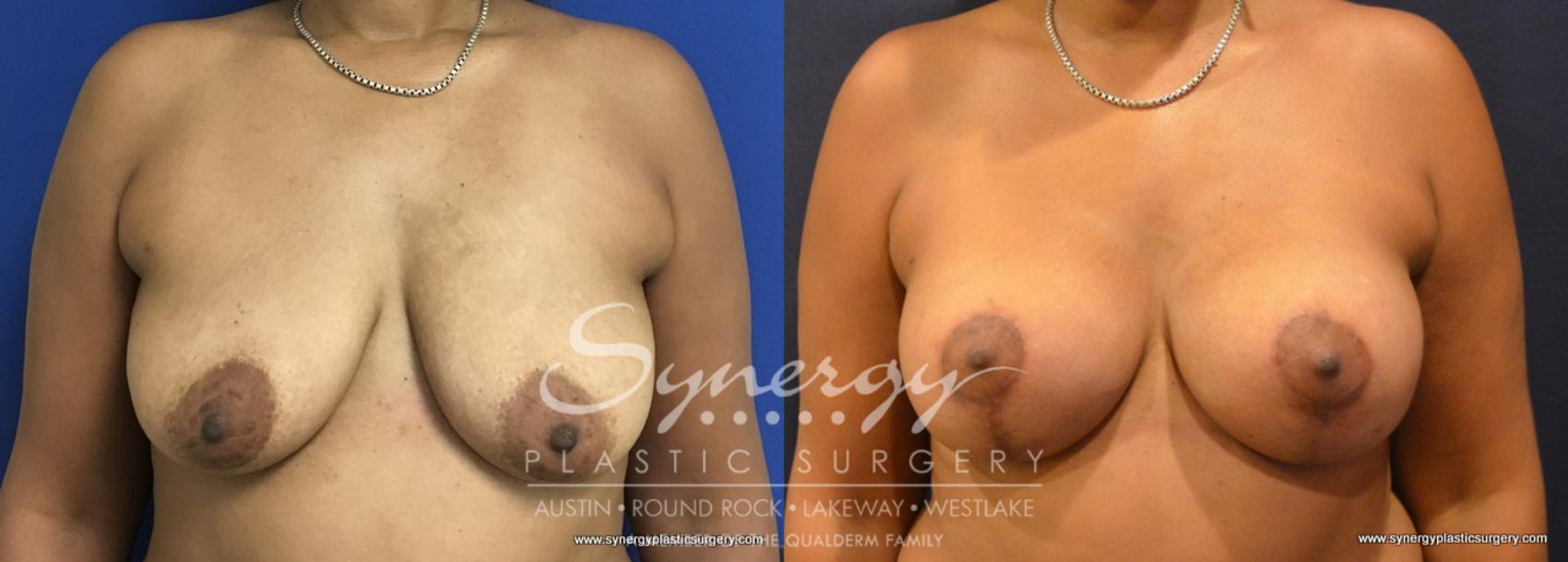 Before & After Breast Lift & Breast Augmentation Case 753 View #1 View in Austin, TX