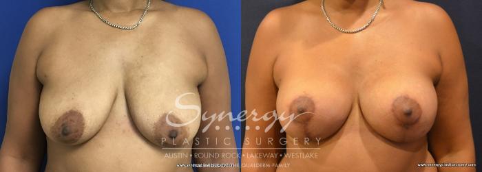 Before & After Breast Lift & Breast Augmentation Case 753 View #1 View in Austin, TX