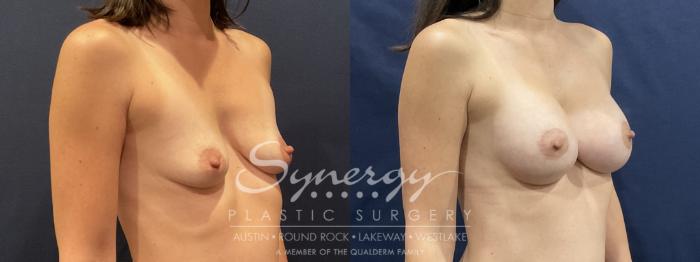 Before & After Breast Lift & Breast Augmentation Case 809 Left Oblique View in Austin, TX