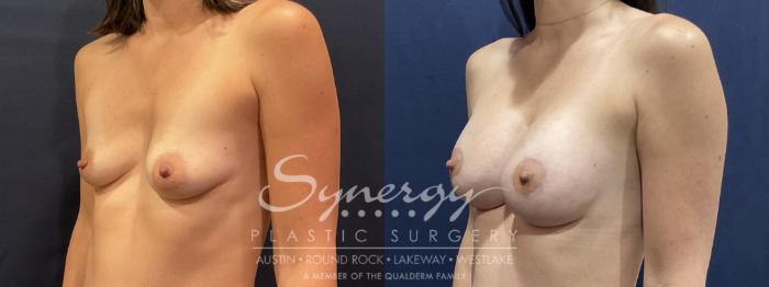 Before & After Breast Lift & Breast Augmentation Case 809 Right Oblique View in Austin, TX