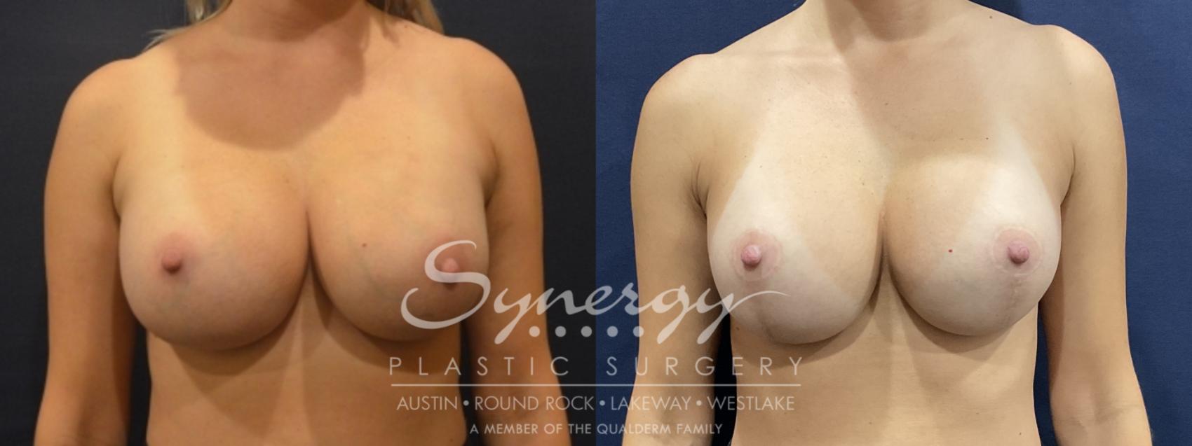 Before & After Breast Lift & Breast Augmentation Case 817 Front View in Austin, TX