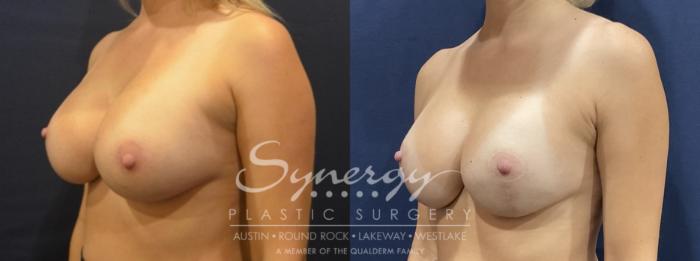 Before & After Breast Lift & Breast Augmentation Case 817 Left Oblique View in Austin, TX