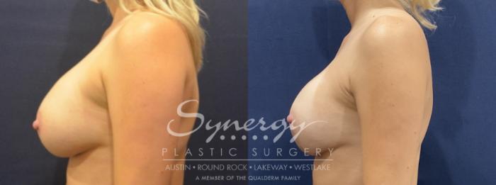 Before & After Breast Lift & Breast Augmentation Case 817 Left Side View in Austin, TX