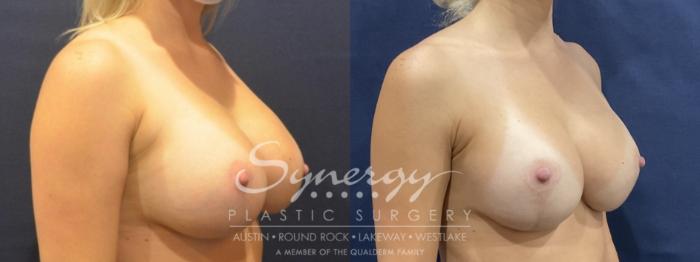Before & After Breast Lift & Breast Augmentation Case 817 Right Oblique View in Austin, TX