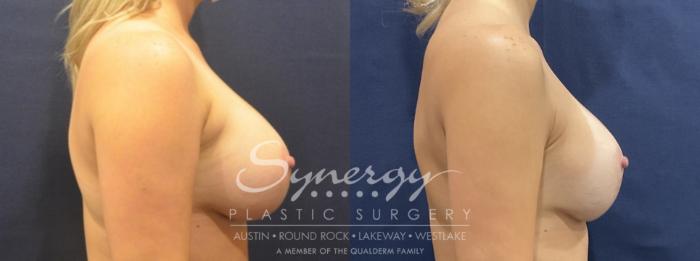Before & After Breast Lift & Breast Augmentation Case 817 Right Side View in Austin, TX