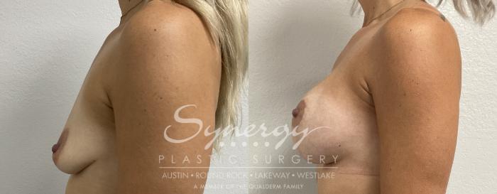 Before & After Breast Lift & Breast Augmentation Case 861 Right Side View in Austin, TX