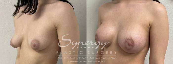 Before & After Breast Lift & Breast Augmentation Case 869 Right Oblique View in Austin, TX