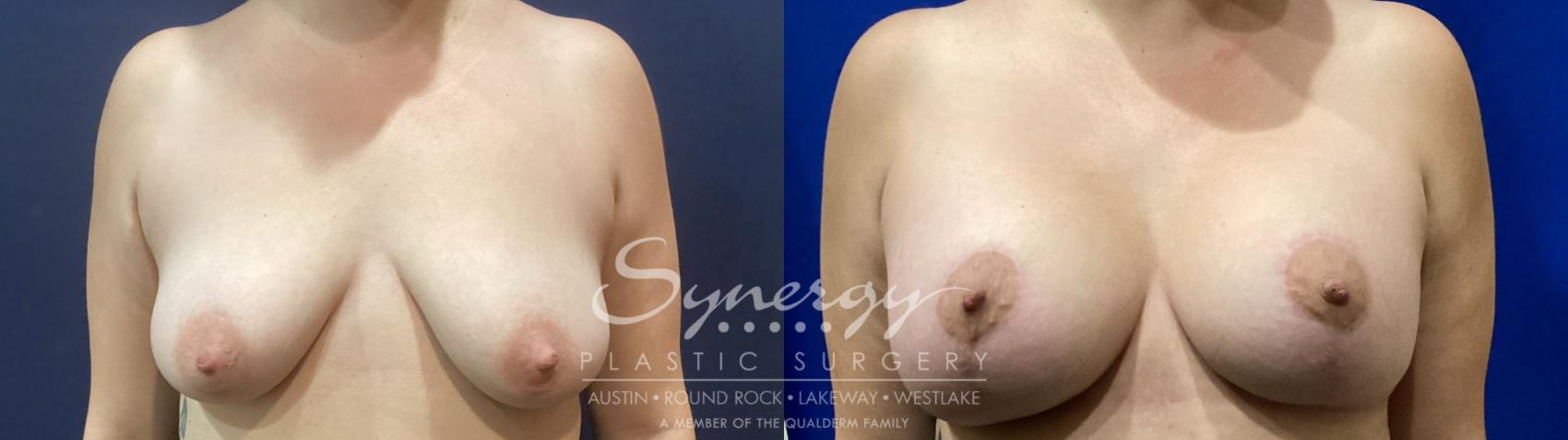Before & After Breast Lift & Breast Augmentation Case 916 Front View in Austin, TX