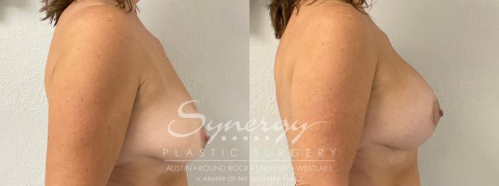 Before & After Breast Lift & Breast Augmentation Case 921 Right Side View in Austin, TX