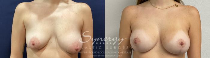 Before & After Breast Lift & Breast Augmentation Case 922 Front View in Austin, TX