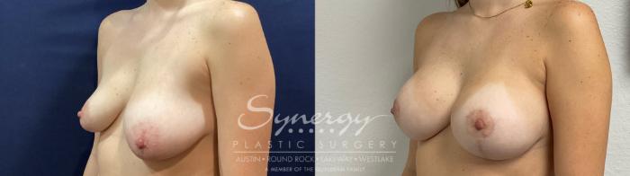 Before & After  Case 922 Left Oblique View in Austin, TX