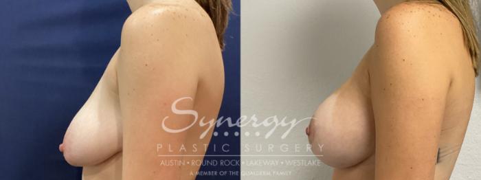 Before & After  Case 922 Left Side View in Austin, TX