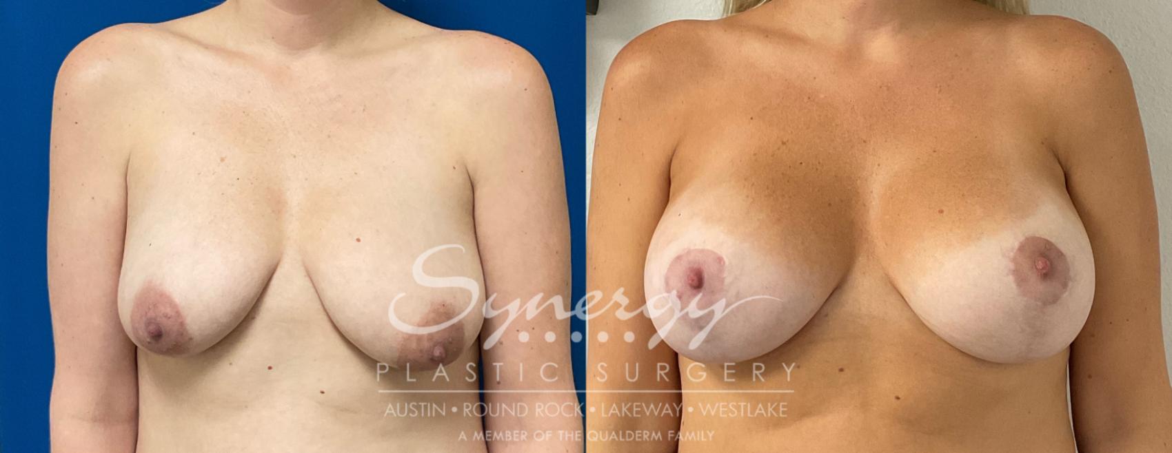Before & After Breast Lift & Breast Augmentation Case 935 Front View in Austin, TX