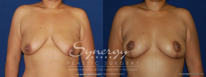 Before & After Breast Lift (Mastopexy) Case 155 View #1 View in Austin, TX