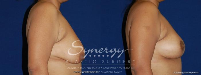 Before & After Breast Lift (Mastopexy) Case 155 View #2 View in Austin, TX