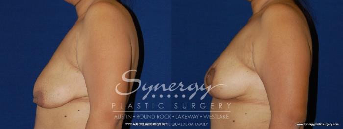 Before & After Breast Lift (Mastopexy) Case 155 View #3 View in Austin, TX