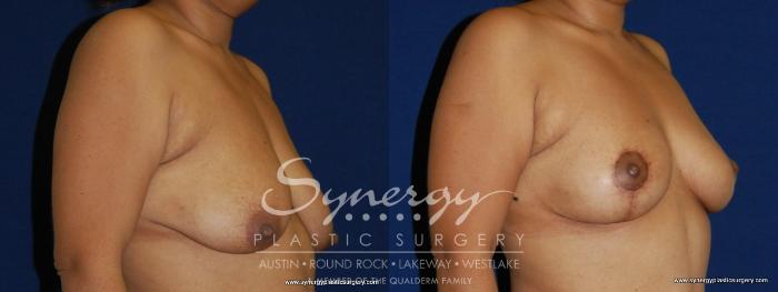 Before & After Breast Lift (Mastopexy) Case 155 View #4 View in Austin, TX