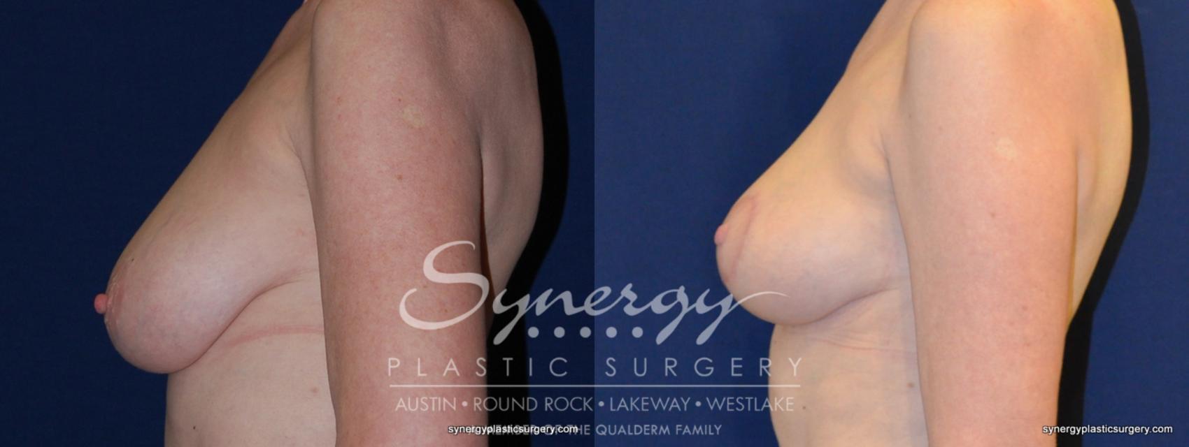 Before & After Breast Lift (Mastopexy) Case 213 View #1 View in Austin, TX