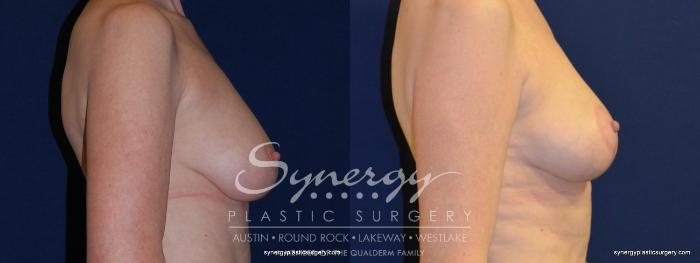 Before & After Breast Lift (Mastopexy) Case 213 View #4 View in Austin, TX