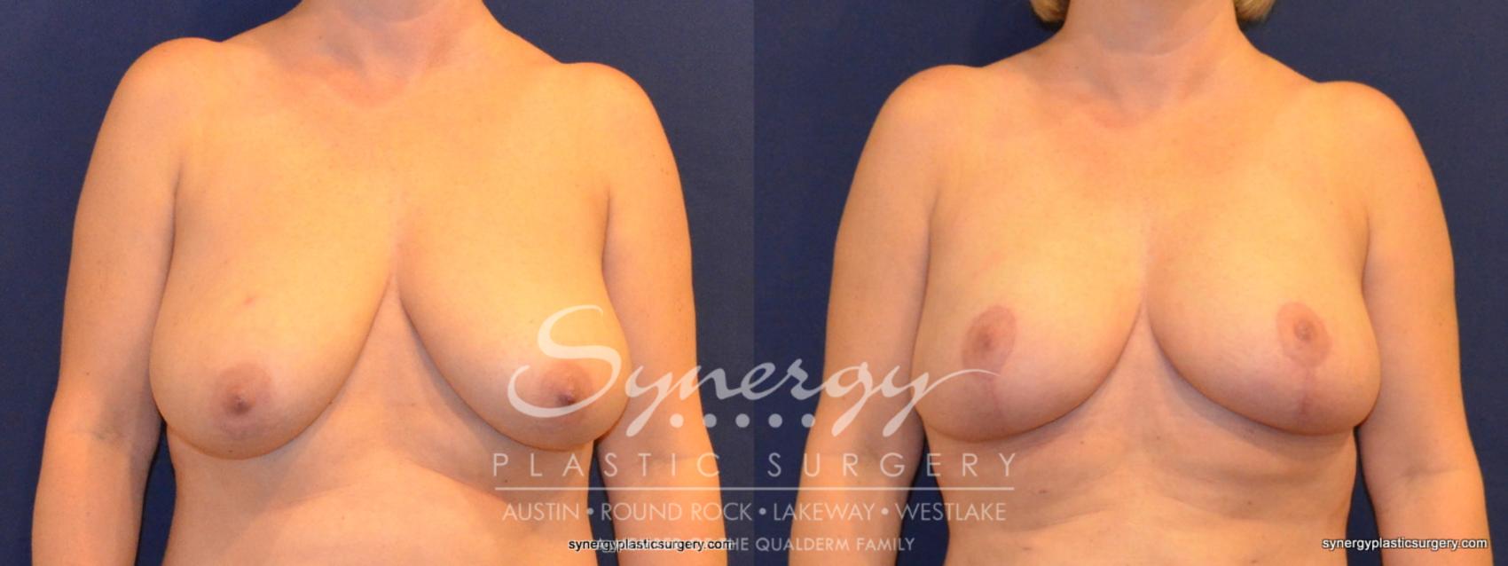 Before & After  Case 332 View #1 View in Austin, TX